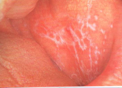 颊轻度糜烂3.jpg